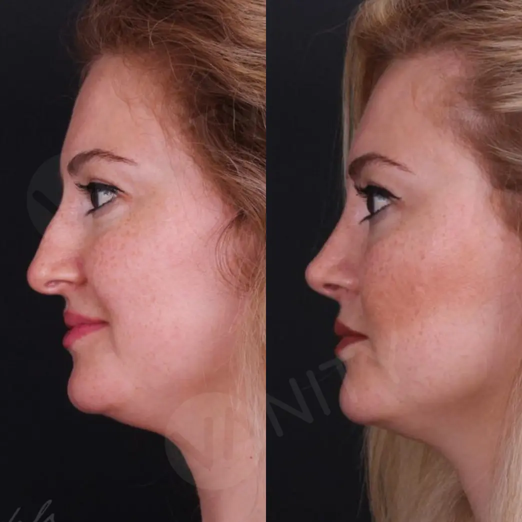 rhinoplasty_ba_5