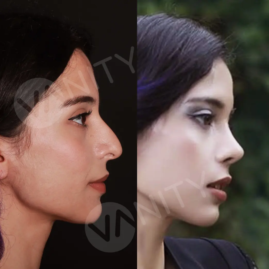 rhinoplasty_ba_1