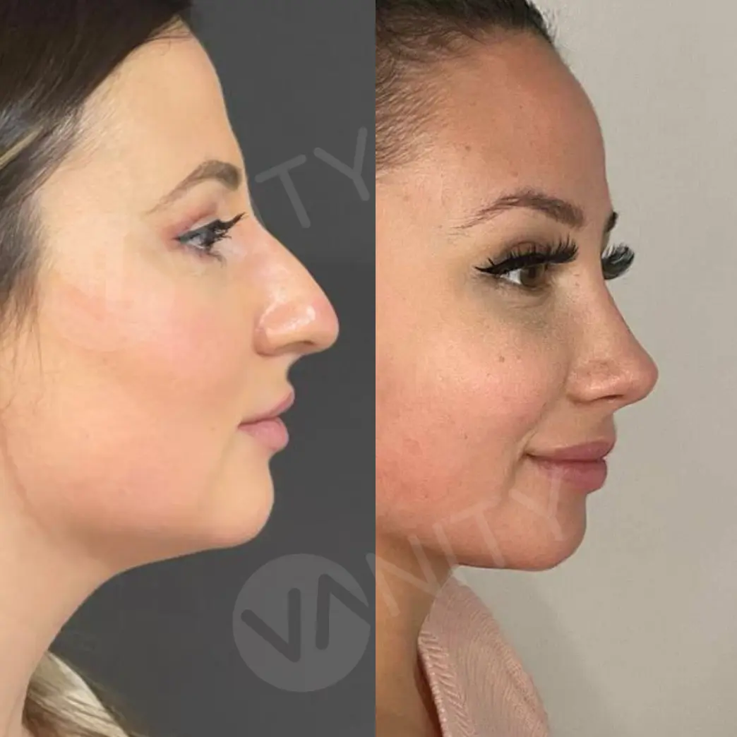 rhinoplasty_ba_2