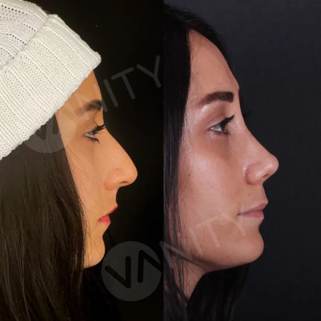 rhinoplasty_ba_3