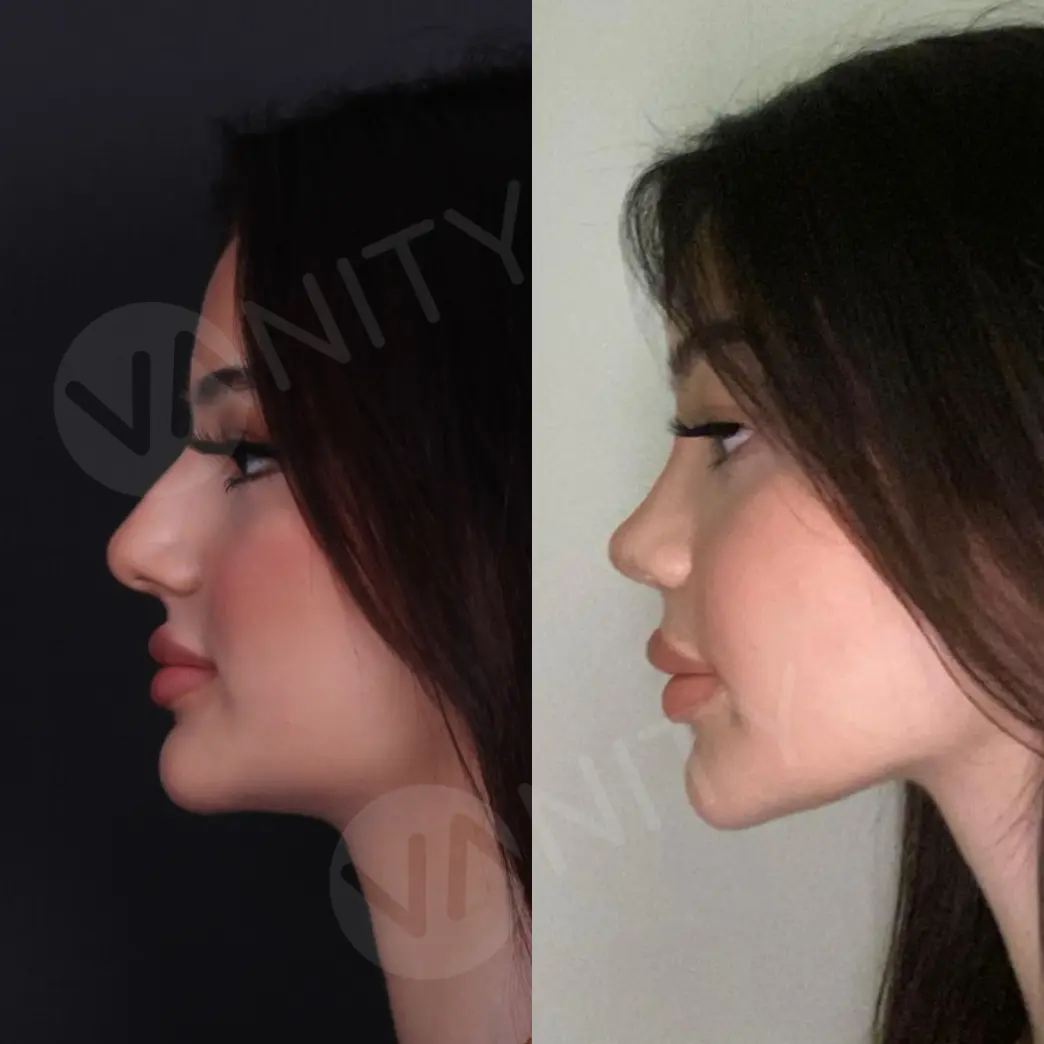 rhinoplasty_ba_6