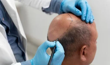 hair_transplant_other_services