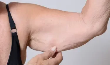 liposuction_other_services